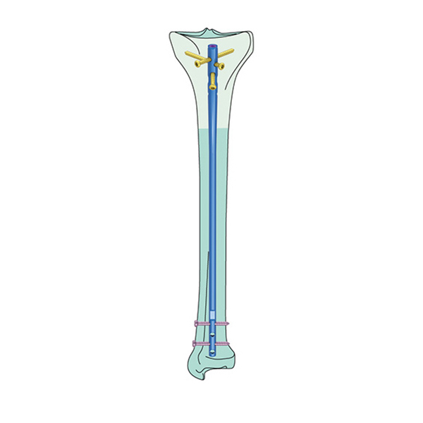 A) This photograph demonstrates cannulated tibia nail (CTN; Synthes ,... |  Download Scientific Diagram